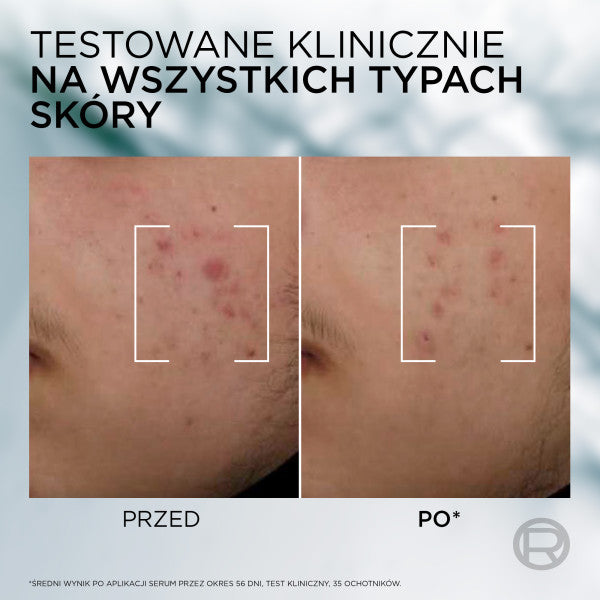 L'Oreal Paris Men Expert Derma Control serum przeciw niedoskonałościom z niacynamidem 30ml